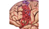Мозговые микрокровоизлияния: обзор и последствия с когнитивными нарушениями